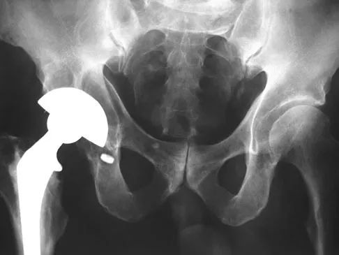 Orthopedic Surgery Board Review 2026 | High-Yield MCQs - Set 1 - Figure 47