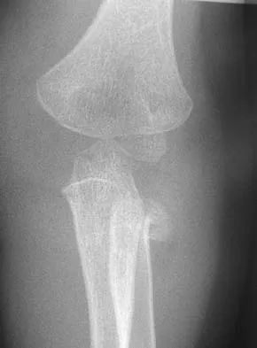 Orthopedic Surgery Board Review 2026 | High-Yield MCQs - Set 1 - Figure 80