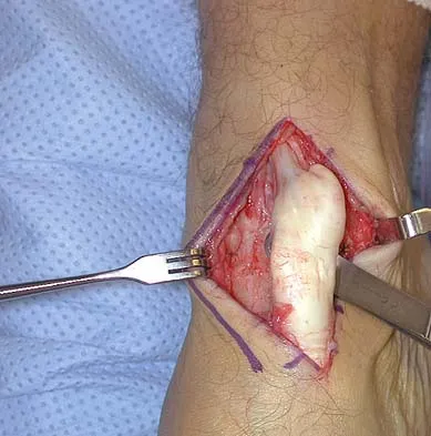 Orthopedic Surgery Board Review 2026 | High-Yield MCQs - Set 2 - Figure 39