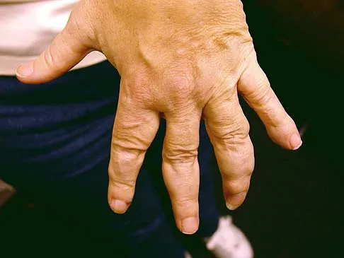 Orthopedic Surgery Board Review 2026 | High-Yield MCQs - Set 2 - Figure 56