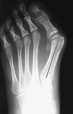 Orthopedic Surgery Board Review 2026 | High-Yield MCQs - Set 2 - Figure 80