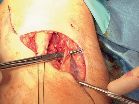 Orthopedic Surgery Board Review 2026 | High-Yield MCQs - Set 3 - Figure 28