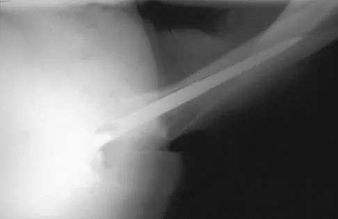 Orthopedic Surgery Board Review 2026 | High-Yield MCQs - Set 3 - Figure 32