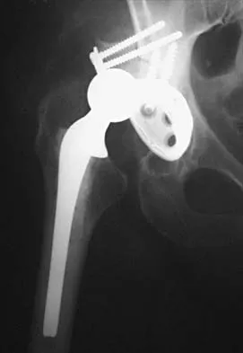 Orthopedic Surgery Board Review 2026 | High-Yield MCQs - Set 3 - Figure 34