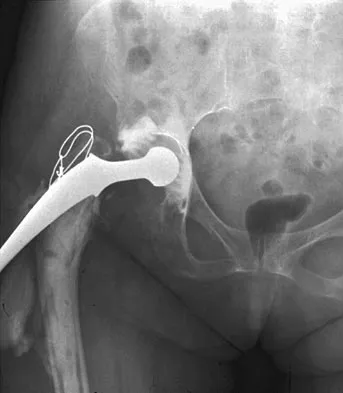 Orthopedic Surgery Board Review 2026 | High-Yield MCQs - Set 3 - Figure 64