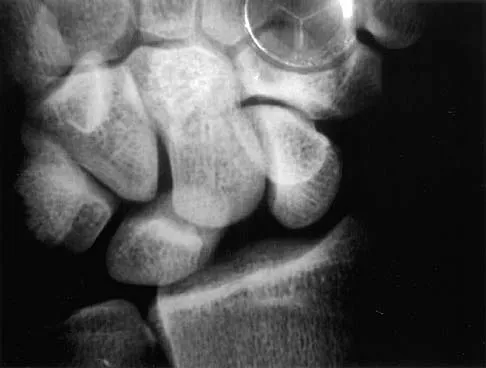 Orthopedic Surgery Board Review 2026 | High-Yield MCQs - Set 3 - Figure 96