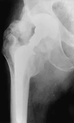 AAOS Orthopedic MCQs (Set 4): Hip & Knee Arthroplasty, Spine Surgery | 2026 Board Review