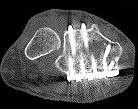 Orthopedic Surgery Board Review 2026 | High-Yield MCQs - Set 4 - Figure 10