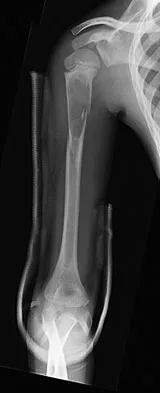 Orthopedic Surgery Board Review 2026 | High-Yield MCQs - Set 4 - Figure 112