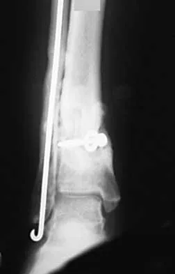 Orthopedic Surgery Board Review 2026 | High-Yield MCQs - Set 4 - Figure 116