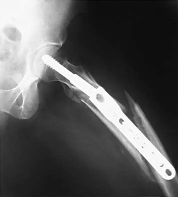 Orthopedic Surgery Board Review 2026 | High-Yield MCQs - Set 4 - Figure 28