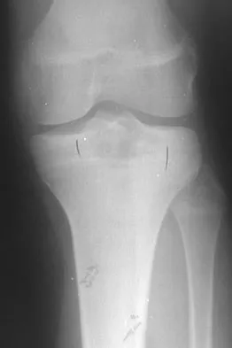 Orthopedic Surgery Board Review 2026 | High-Yield MCQs - Set 4 - Figure 34