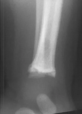 Orthopedic Surgery Board Review 2026 | High-Yield MCQs - Set 5 - Figure 106