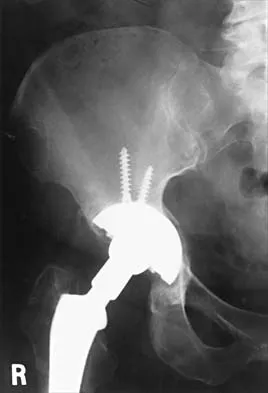 Orthopedic Surgery Board Review 2026 | High-Yield MCQs - Set 5 - Figure 109