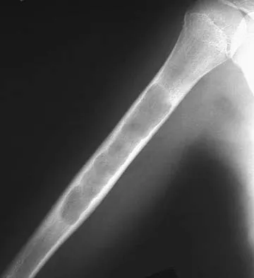 Orthopedic Surgery Board Review 2026 | High-Yield MCQs - Set 5 - Figure 28