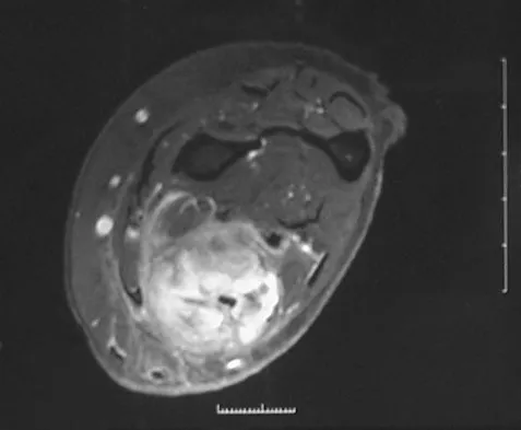 Orthopedic Surgery Board Review 2026 | High-Yield MCQs - Set 5 - Figure 61