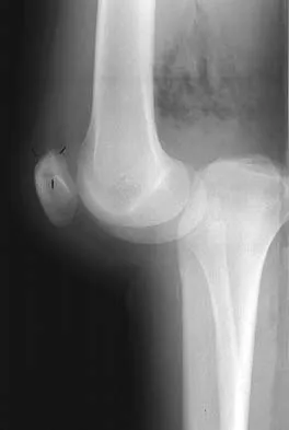 Orthopedic Surgery Board Review 2026 | High-Yield MCQs - Set 5 - Figure 88