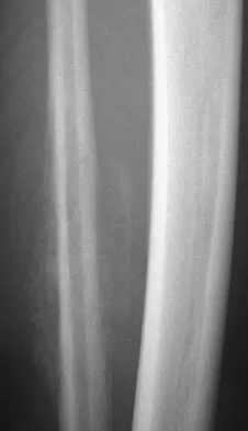 Orthopedic Surgery Board Review 2026 | High-Yield MCQs - Set 5 - Figure 90