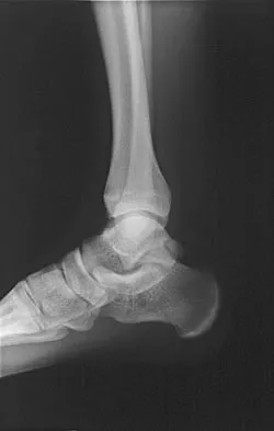 Orthopedic MCQs (Set 6): Spine, Foot & Ankle, Shoulder & Elbow Pathology | SMLE, DHA, Prometric, AAOS Board Review
