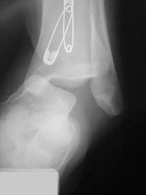 Orthopedic Surgery Board Review 2026 | High-Yield MCQs - Set 6 - Figure 51