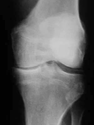 Orthopedic Surgery Board Review 2026 | High-Yield MCQs - Set 6 - Figure 73