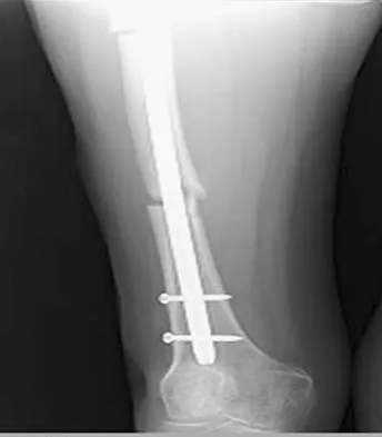 Orthopedic Surgery Board Review 2026 | High-Yield MCQs - Set 6 - Figure 86