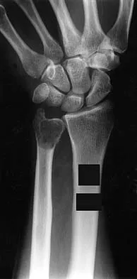 Orthopedic Surgery Board Review 2026 | High-Yield MCQs - Set 6 - Figure 96