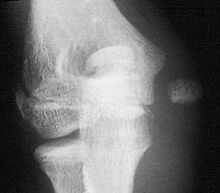 Orthopedic Surgery Board Review 2026 | High-Yield MCQs - Set 7 - Figure 95