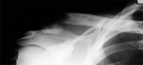 Orthopedic MCQs (Set 8): Spine Trauma, Shoulder Instability & Foot/Ankle Injuries | ABOS, AAOS Review