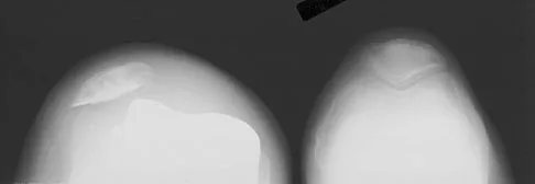 Orthopedic Surgery Board Review 2026 | High-Yield MCQs - Set 8 - Figure 105