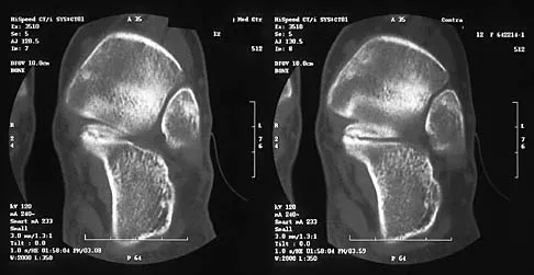 Orthopedic Surgery Board Review 2026 | High-Yield MCQs - Set 8 - Figure 64