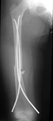 Orthopedic Surgery Board Review 2026 | High-Yield MCQs - Set 8 - Figure 80