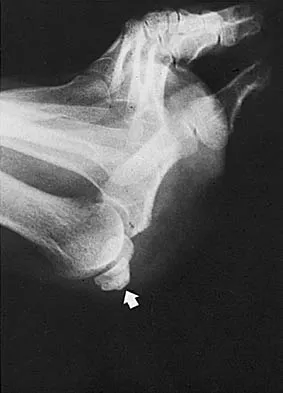 Orthopedic Surgery Board Review 2026 | High-Yield MCQs - Set 9 - Figure 108