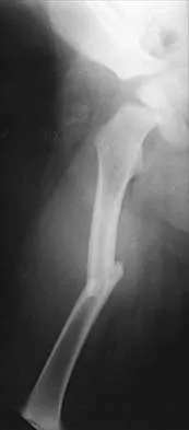 AAOS Pediatrics Board Review MCQs (Set 2): DDH, Fractures & Scoliosis | ABOS 2001