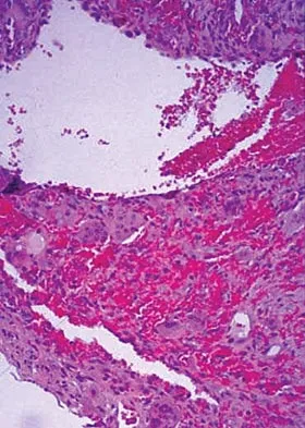 Pediatrics 2004 Practice Questions: Set 1 (Solved) - Figure 12