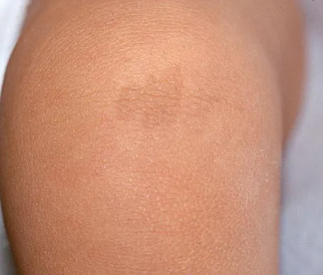 Pediatrics Board Review 2004: High-Yield MCQs (Set 2) - Figure 22