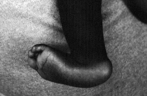 Pediatrics 2007 Practice Questions: Set 1 (Solved) - Figure 21