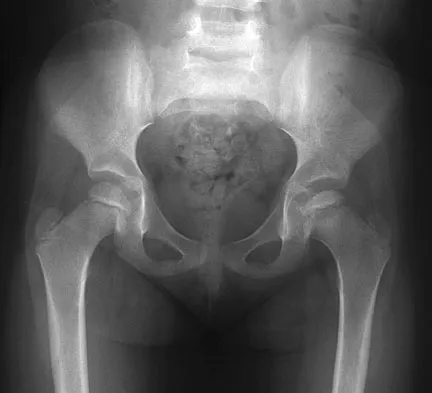 AAOS Pediatric Orthopedic MCQs (Set 2): DDH, SCFE & Spinal Deformities | Board Review