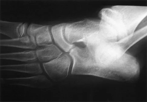 Pediatric Orthopedic MCQs (Set 4): DDH, SCFE, & Scoliosis for ABOS/OITE Exams