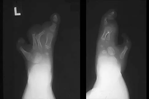 AAOS Orthopedic Pediatrics MCQs (Part 1): DDH, Femur Fractures & SCFE | 2026 Board Review