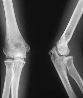 AAOS/ABOS Pediatric Orthopedics MCQs (Part 3): Scoliosis, DDH & Growth Plate Injuries | 2026 Board Review