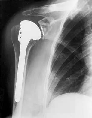 Shoulder 2000 Practice Questions: Set 1 (Solved) - Figure 22