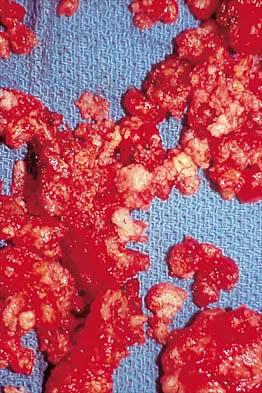 Shoulder Board Review 2000: High-Yield MCQs (Set 2) - Figure 12