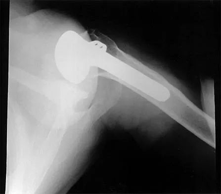 Shoulder Board Review 2000: High-Yield MCQs (Set 4) - Figure 7