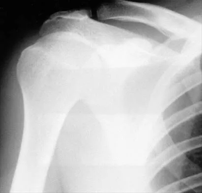 Shoulder Board Review 2002: High-Yield MCQs (Set 2) - Figure 33