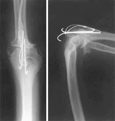 ABOS Shoulder MCQs (Set 3): Rotator Cuff & Glenoid Instability | OITE & Board Prep
