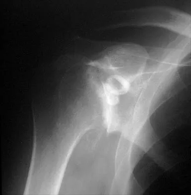 Shoulder 2026 MCQs: Board Review Questions & Answers (Part 1) - Figure 107