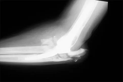 Shoulder 2026 MCQs: Board Review Questions & Answers (Part 1) - Figure 33