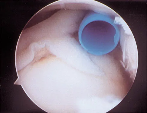 Shoulder 2026 MCQs: Board Review Questions & Answers (Part 1) - Figure 83