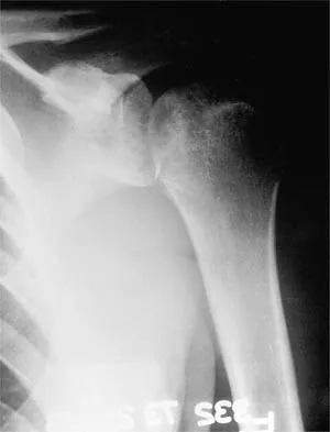 Orthopedic Shoulder 2026 MCQs (Part 2): Rotator Cuff, Instability & Proximal Humerus Fractures | Board Review